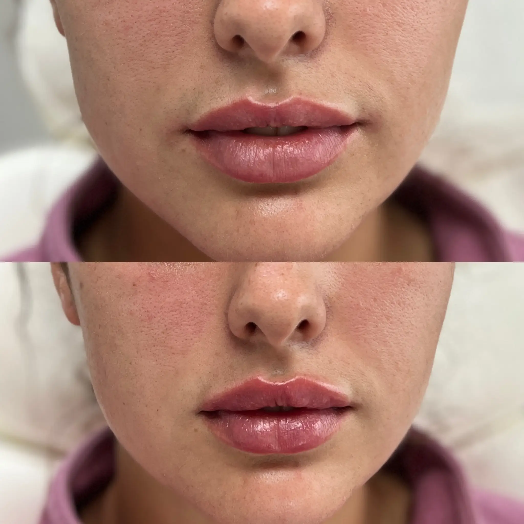 Facial Filler Gallery A in Stillwater, OK