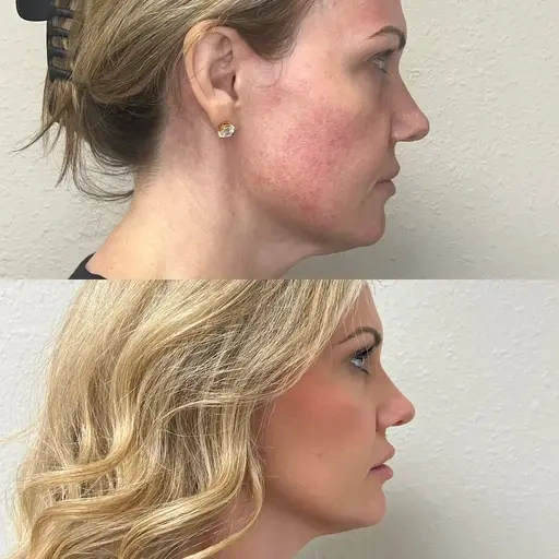 Facial Filler Gallery O in Stillwater, OK