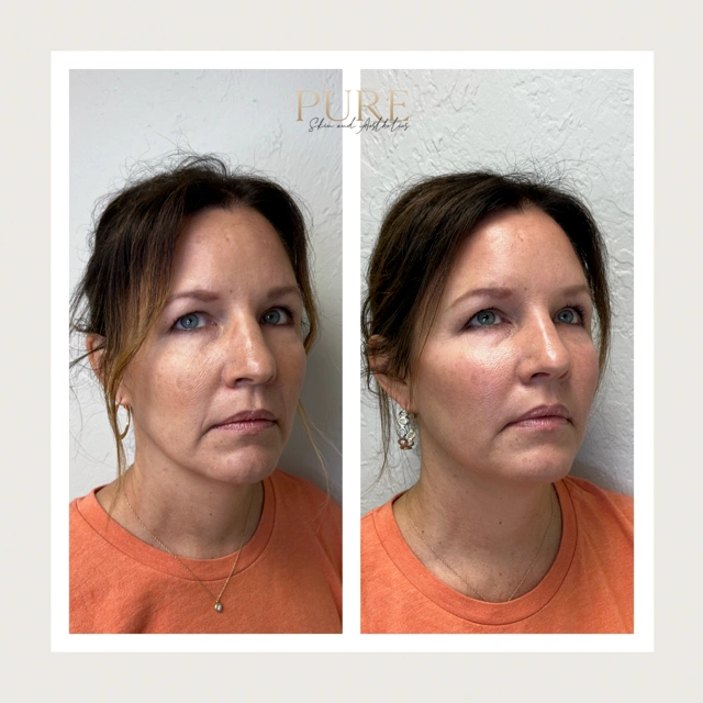Facial Filler Gallery d in Stillwater, OK
