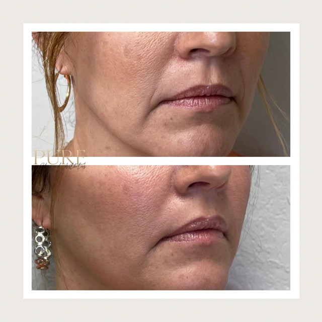 Facial Filler Gallery g in Stillwater, OK