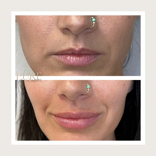 Facial Filler Gallery j in Stillwater, OK
