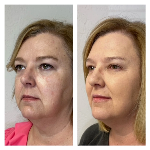 Facial Filler Gallery m in Stillwater, OK
