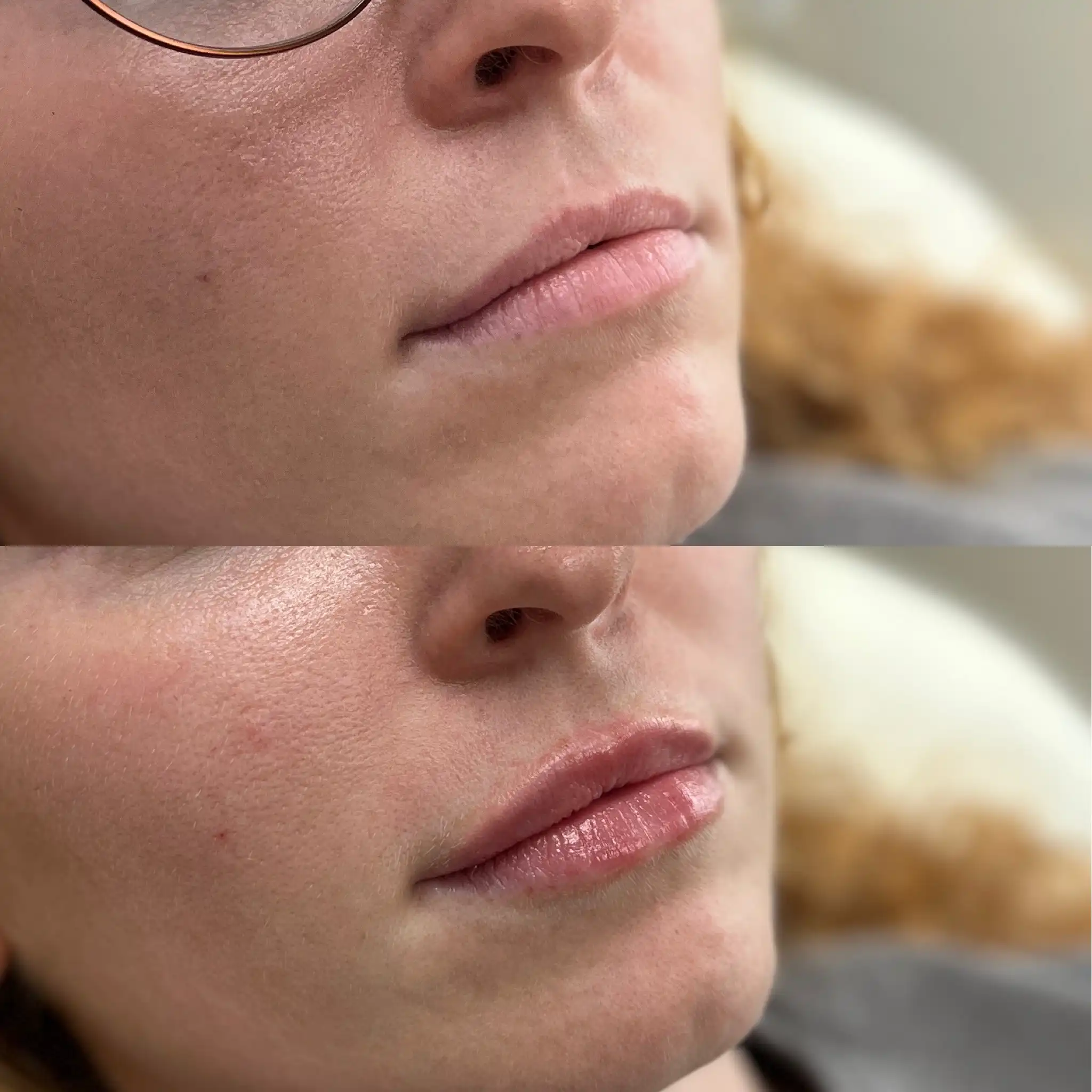 Lip Filler Gallery A in Stillwater, OK.webp