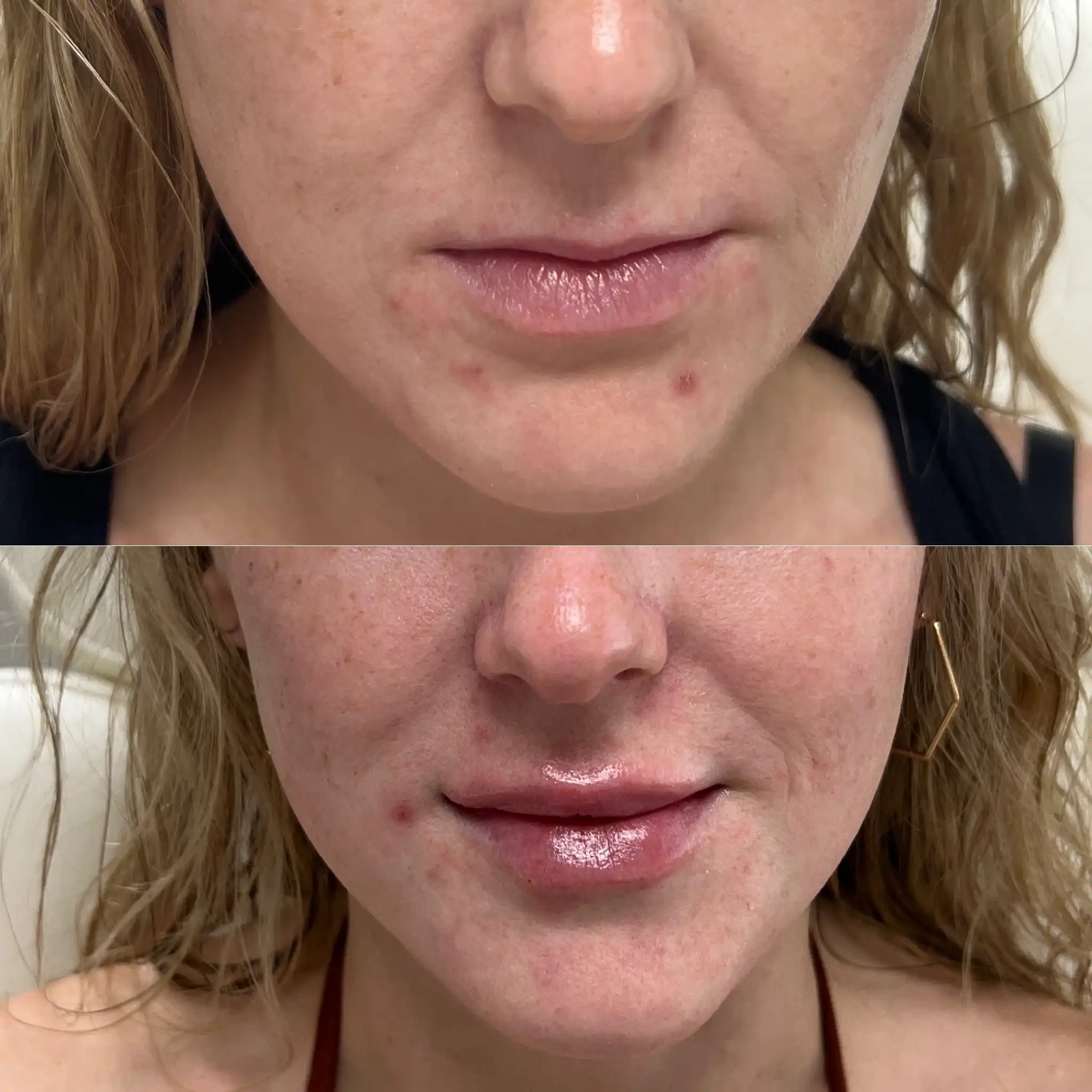 Lip Filler Gallery C in Stillwater, OK.webp