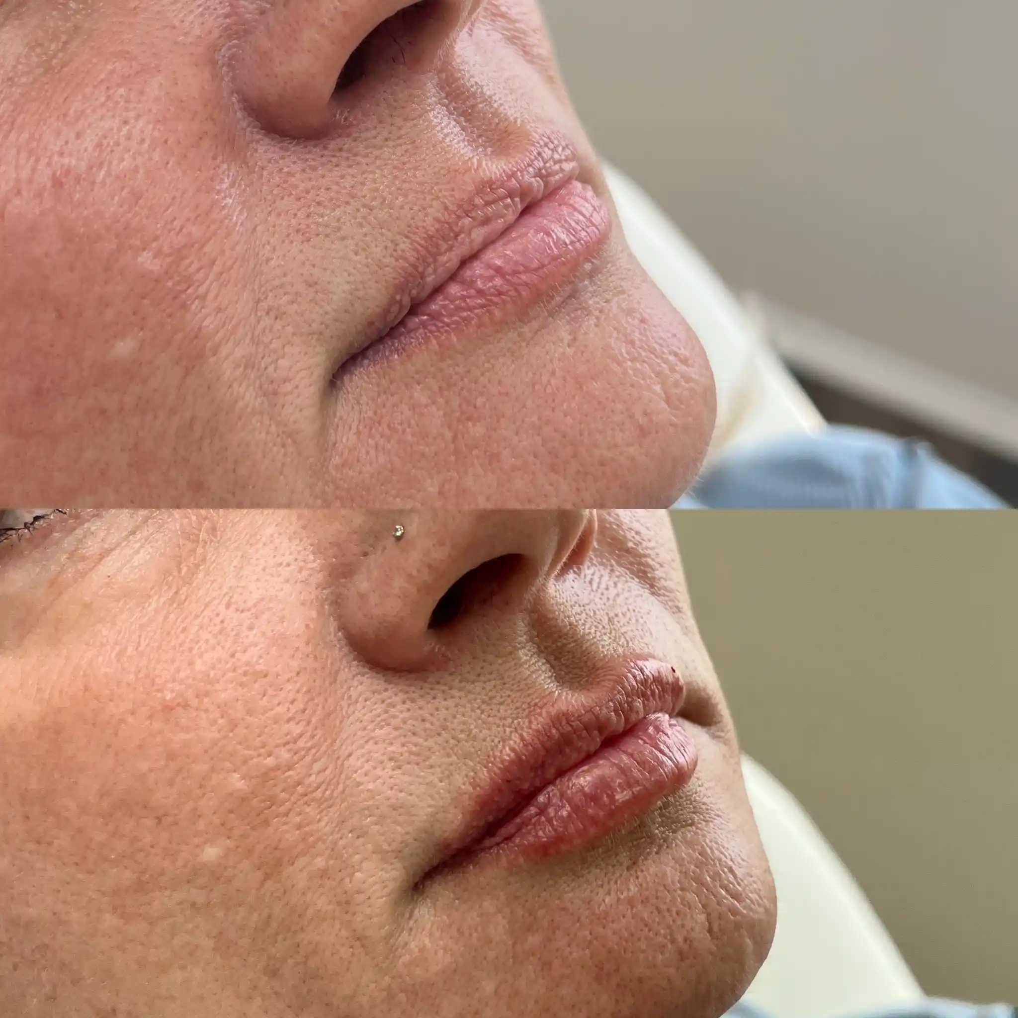Lip Filler Gallery F in Stillwater, OK.webp