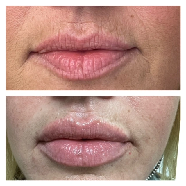 Lip Filler Gallery G in Stillwater, OK.webp
