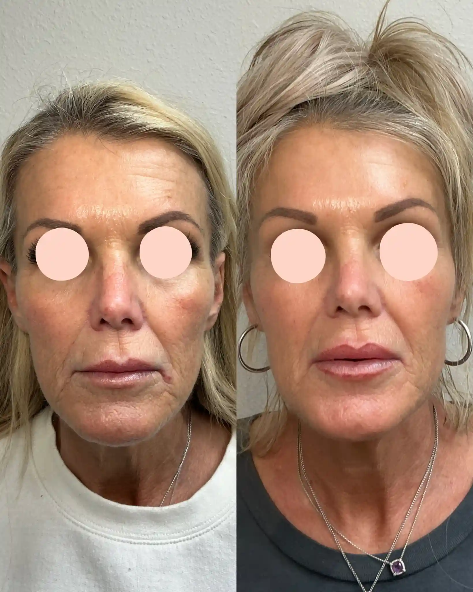 EZ Gel_Regenerative B-Pure Skin and Aesthetics in-Stillwater-OK