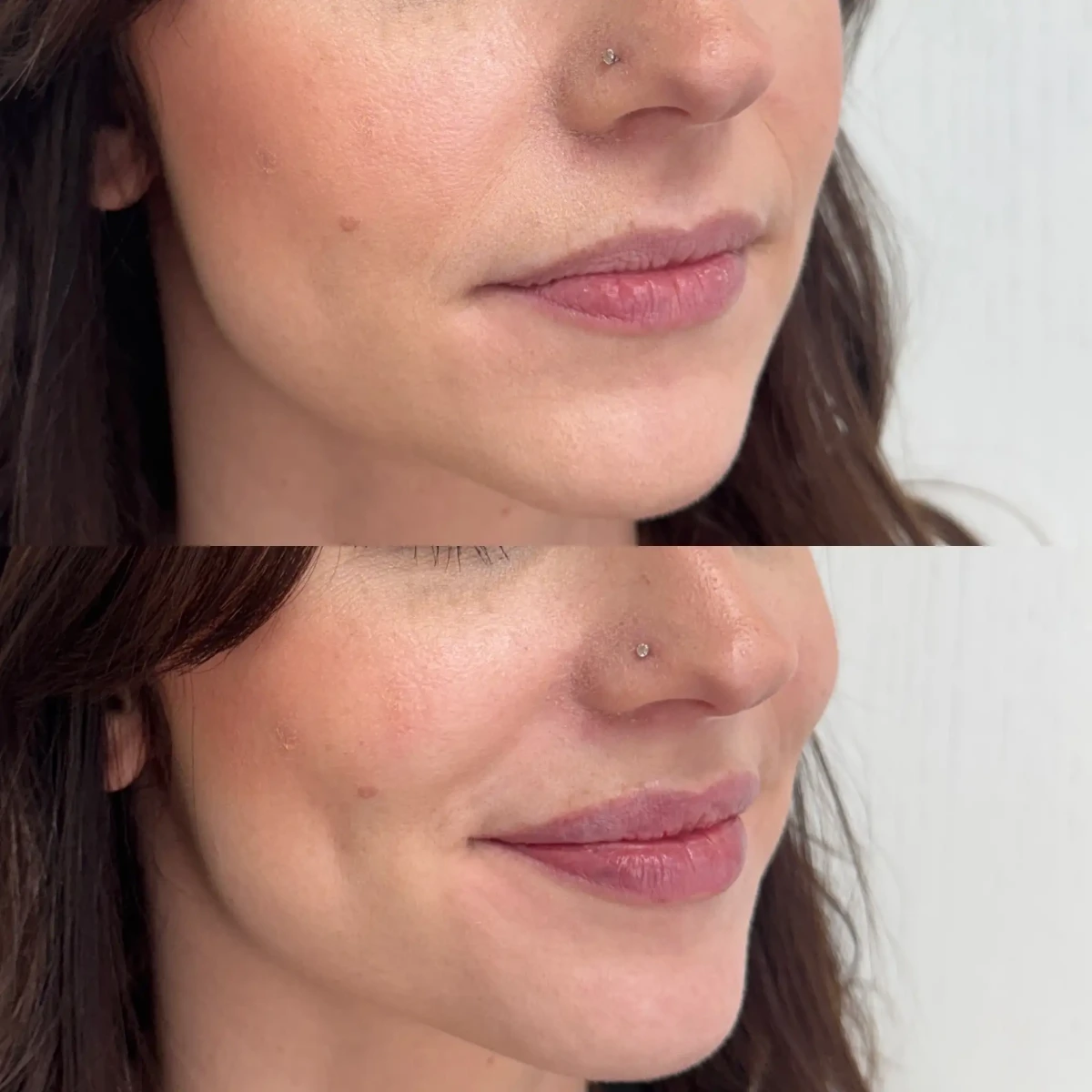 Filler 0-Pure Skin and Aesthetics in-Stillwater-OK