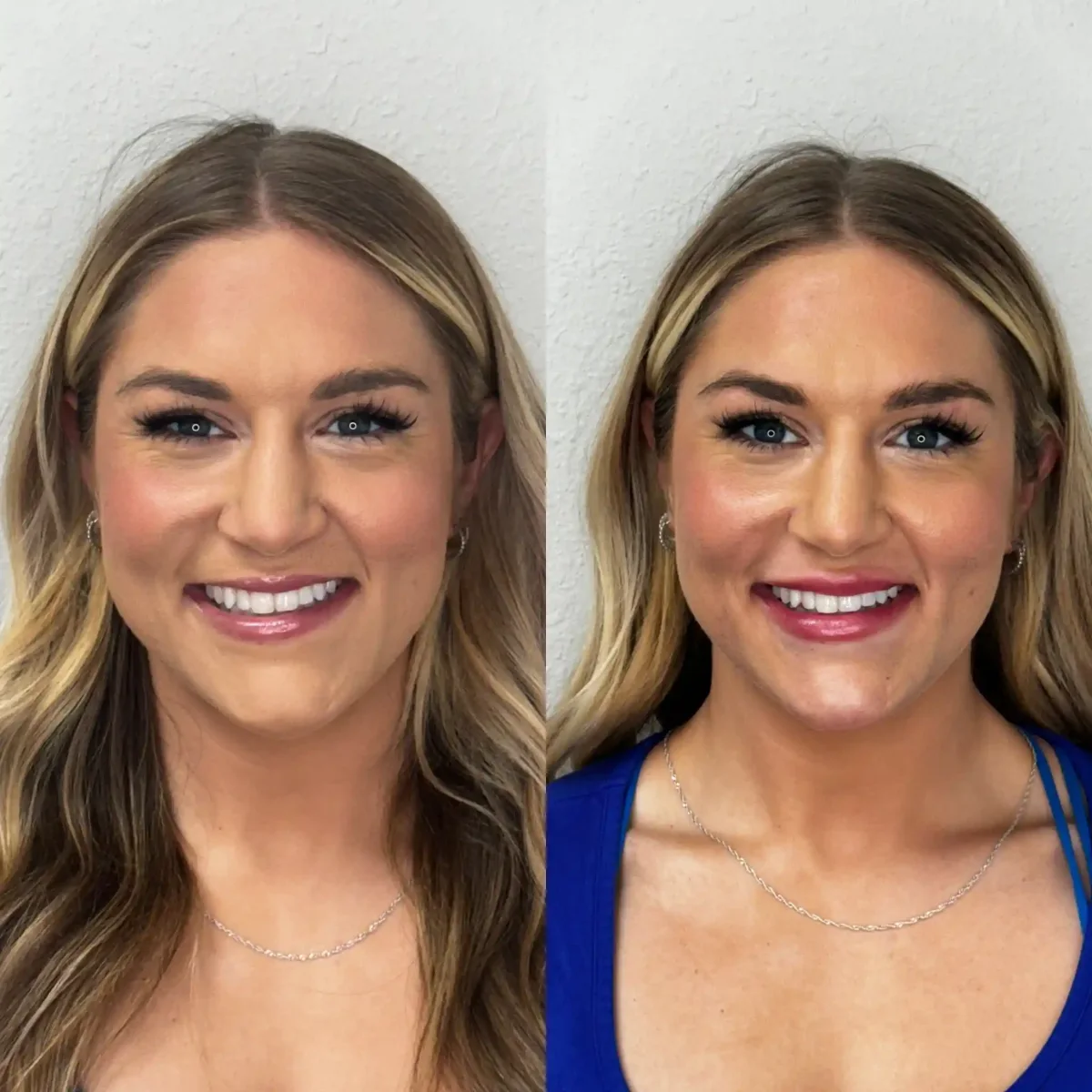 Filler AA-Pure Skin and Aesthetics in-Stillwater-OK