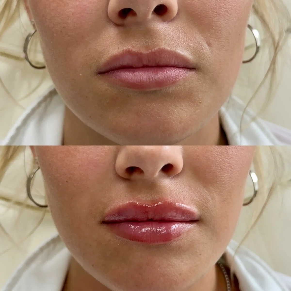 Filler Ad-Pure Skin and Aesthetics in-Stillwater-OK