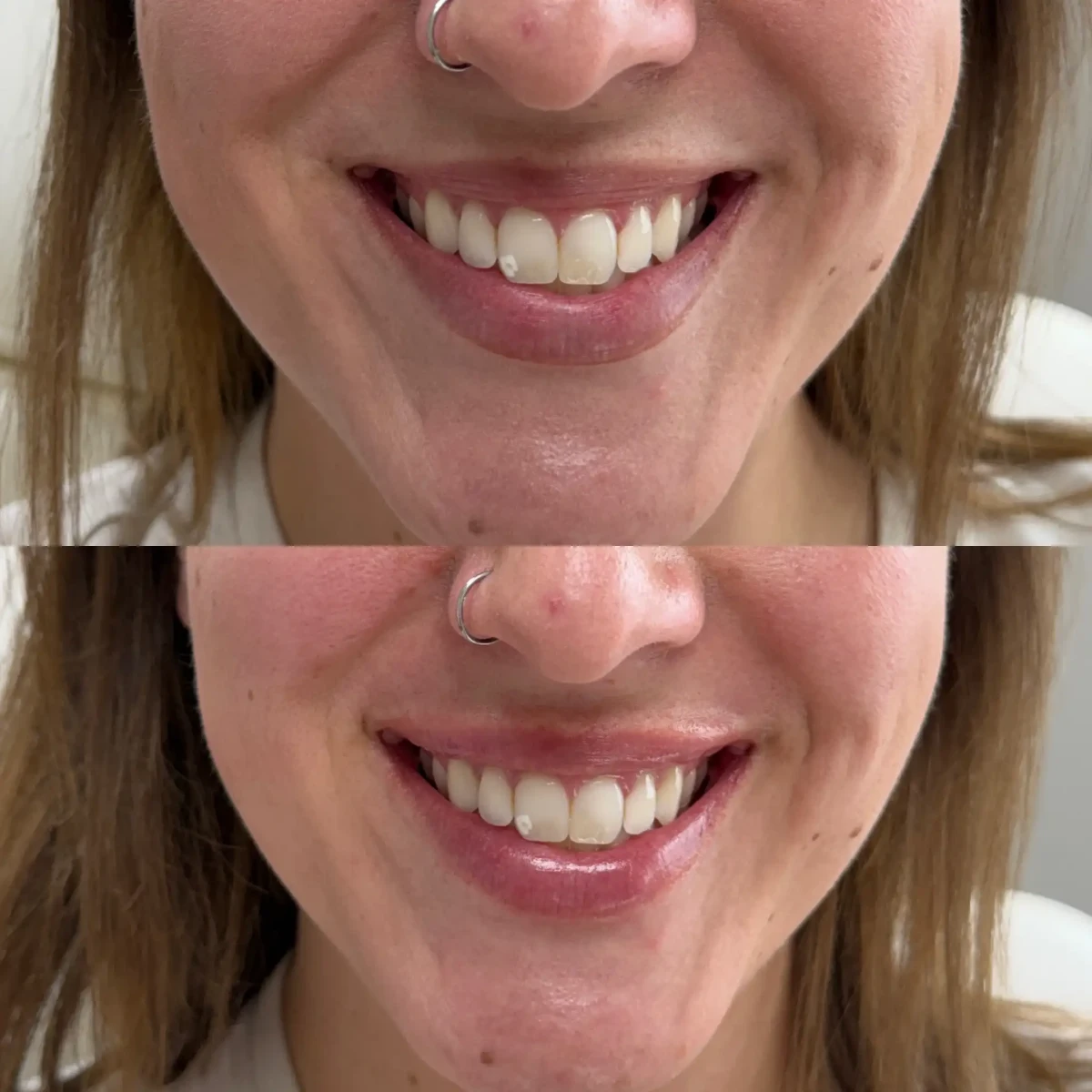 Filler Q-Pure Skin and Aesthetics in-Stillwater-OK
