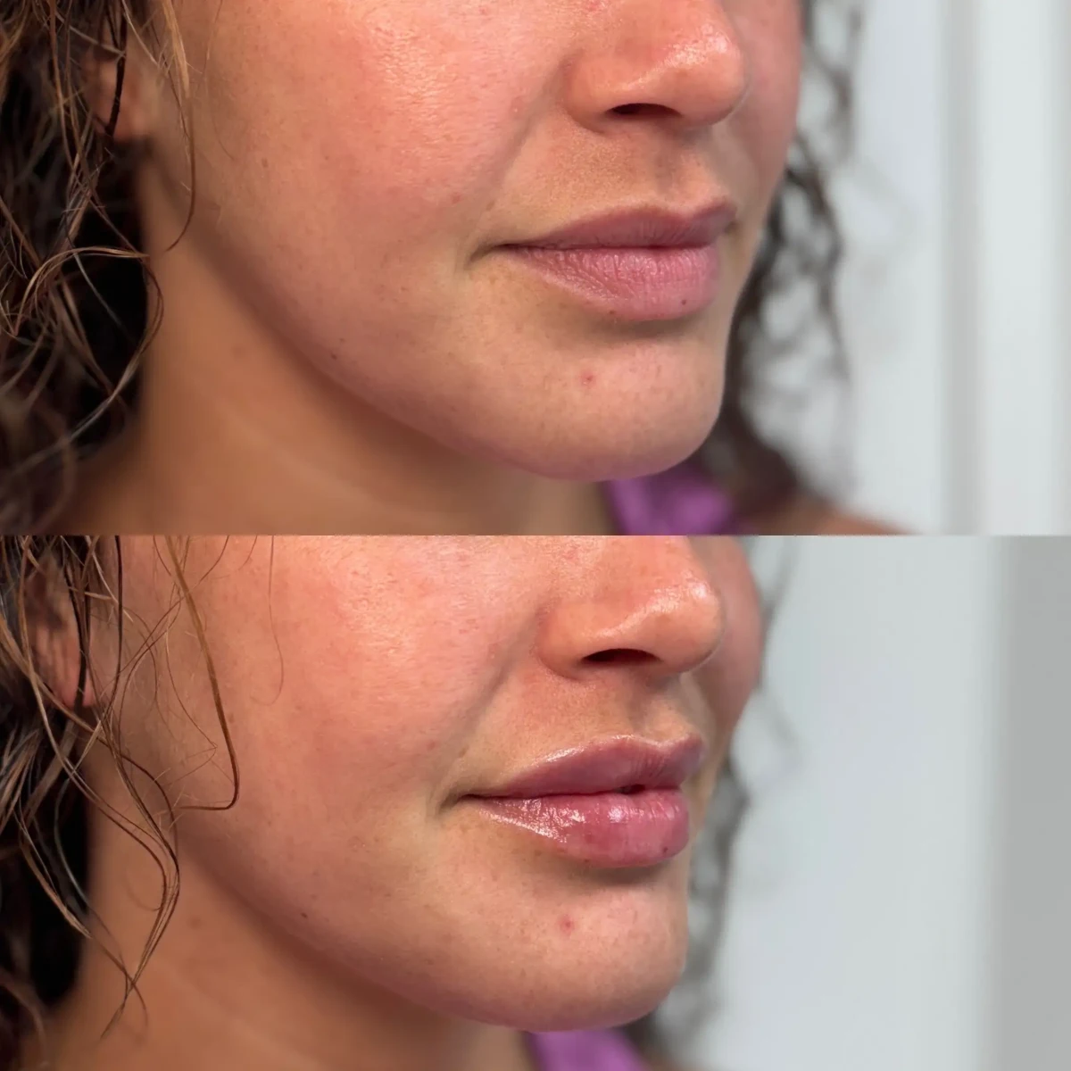Filler a-Pure Skin and Aesthetics in-Stillwater-OK