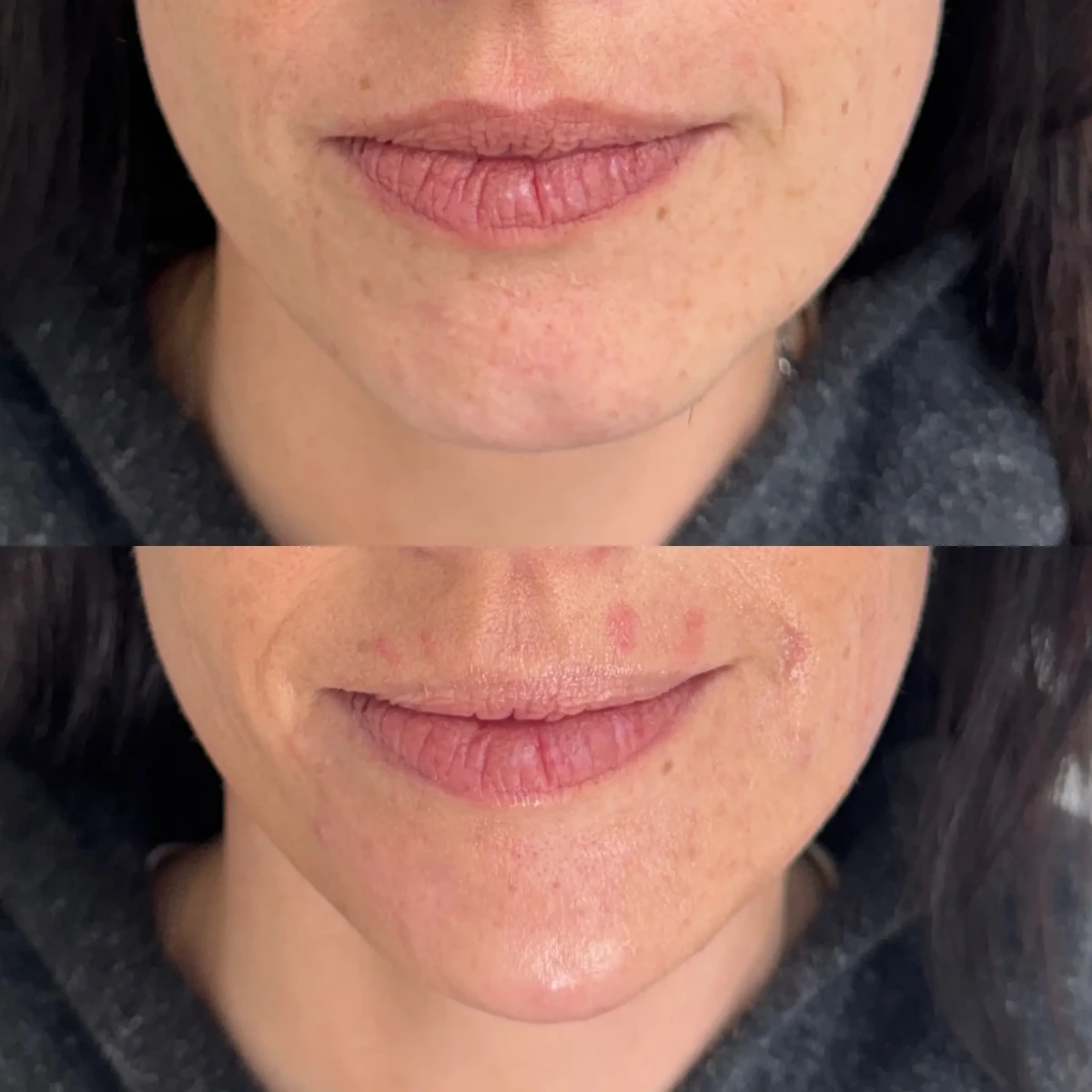 Filler c-Pure Skin and Aesthetics in-Stillwater-OK