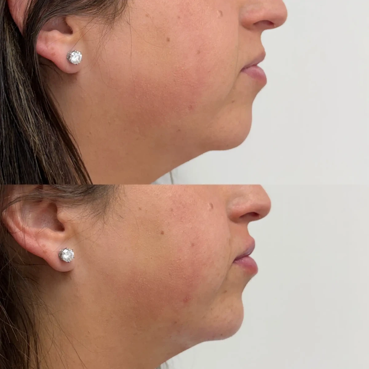 Filler g-Pure Skin and Aesthetics in-Stillwater-OK