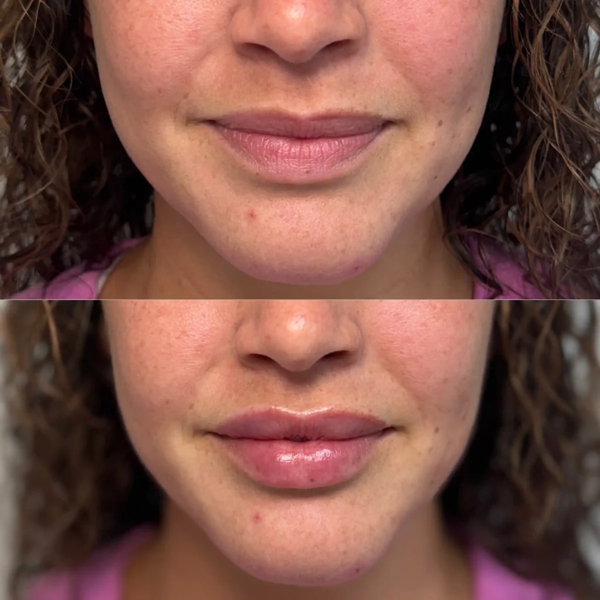 Filler h-Pure Skin and Aesthetics in-Stillwater-OK