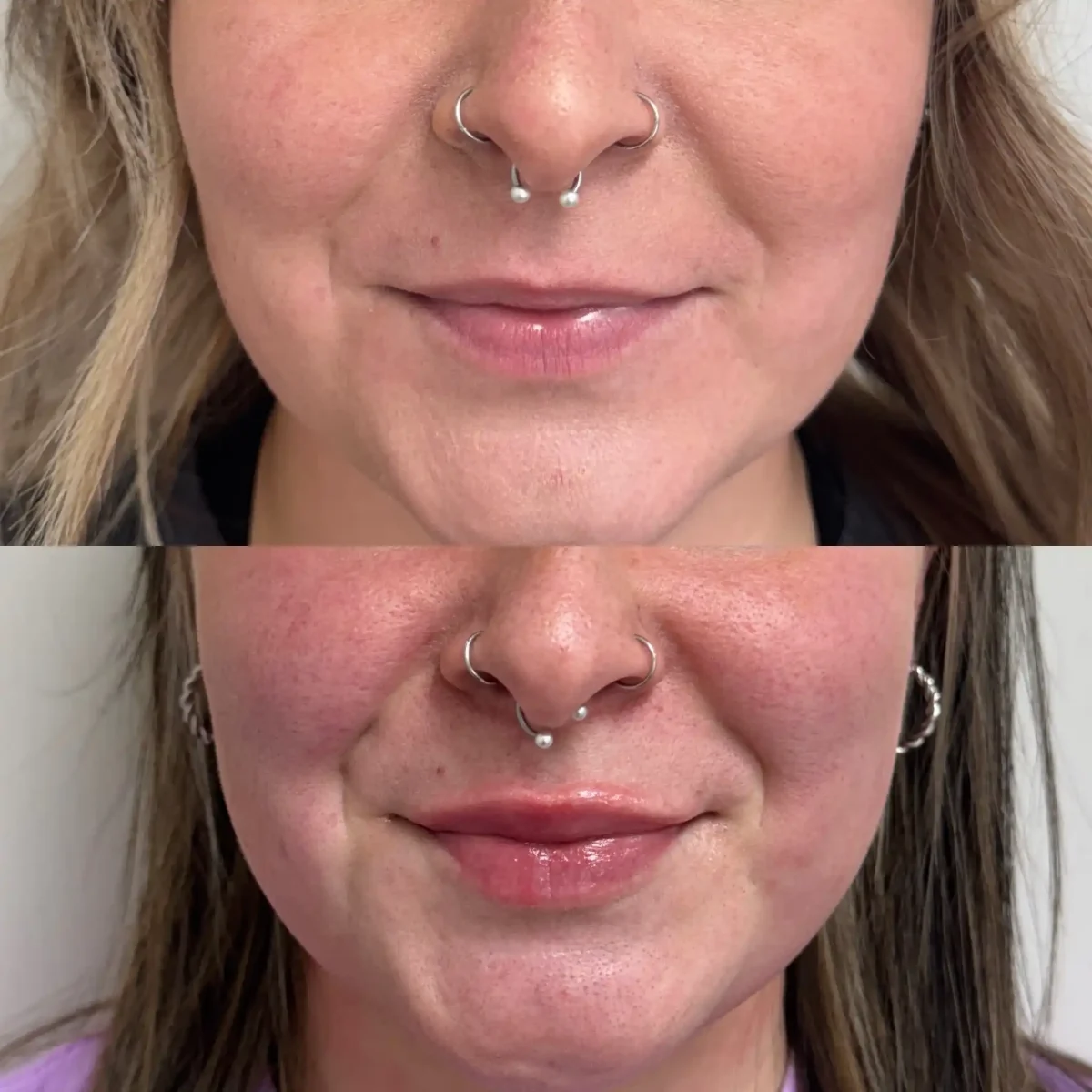 Filler j-Pure Skin and Aesthetics in-Stillwater-OK (1)