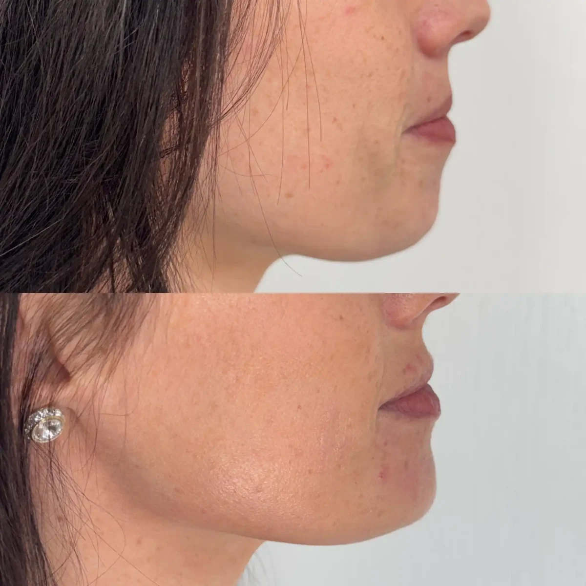 Filler k-Pure Skin and Aesthetics in-Stillwater-OK