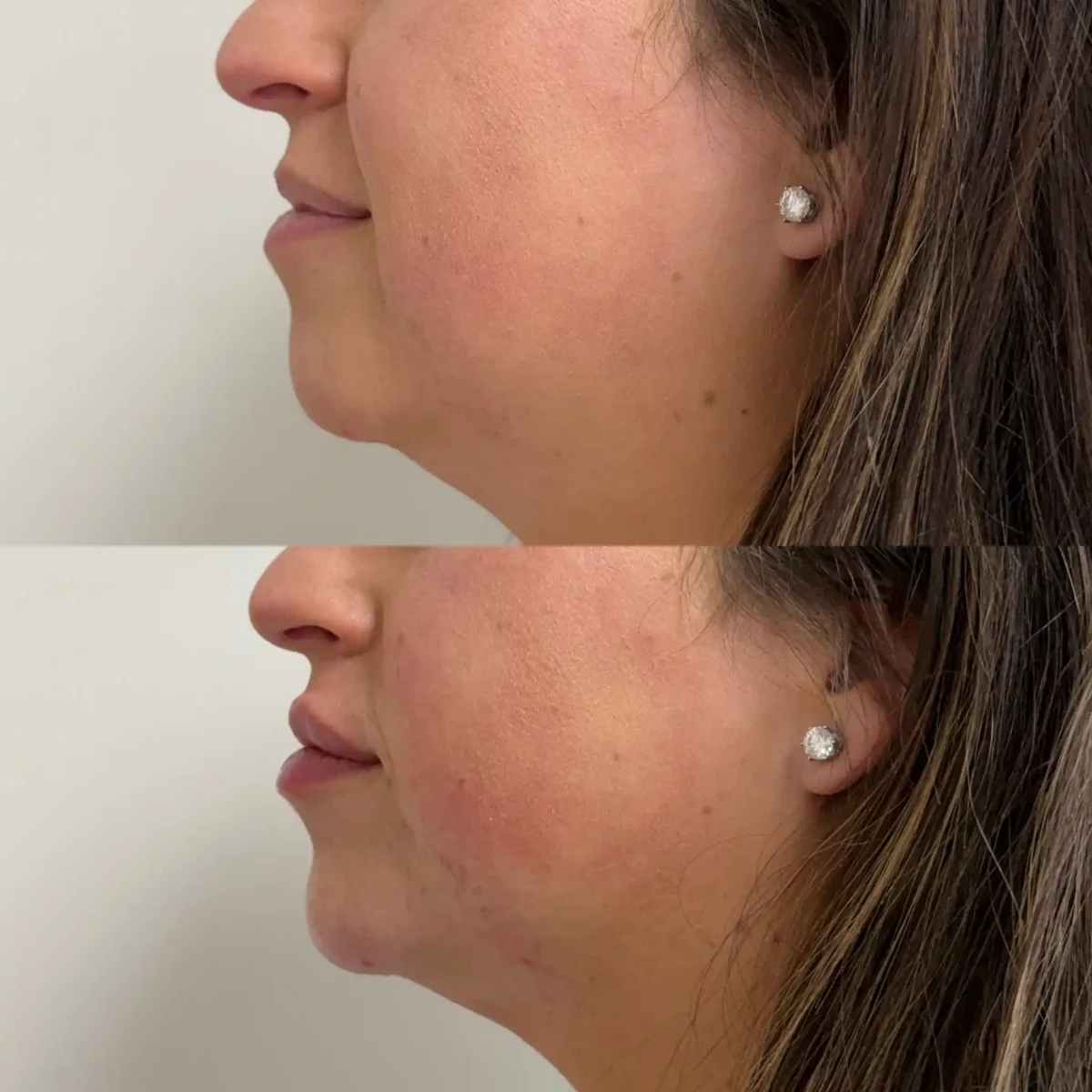 Filler l-Pure Skin and Aesthetics in-Stillwater-OK