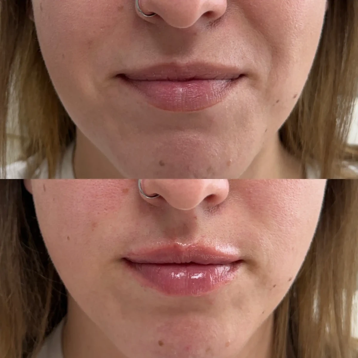 Filler m-Pure Skin and Aesthetics in-Stillwater-OK