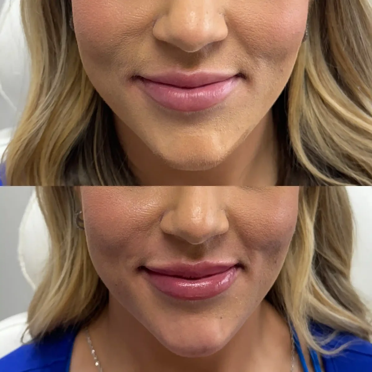 Filler n-Pure Skin and Aesthetics in-Stillwater-OK