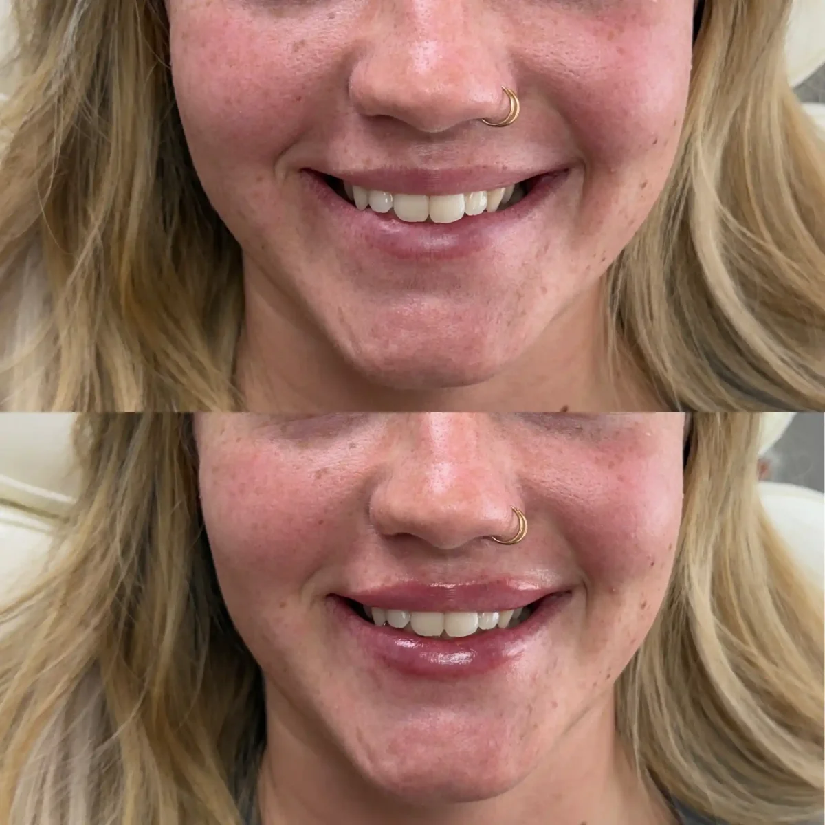 Filler p-Pure Skin and Aesthetics in-Stillwater-OK