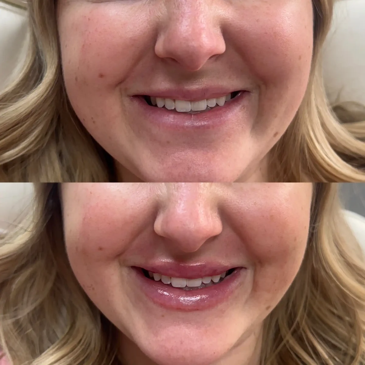 Filler r-Pure Skin and Aesthetics in-Stillwater-OK
