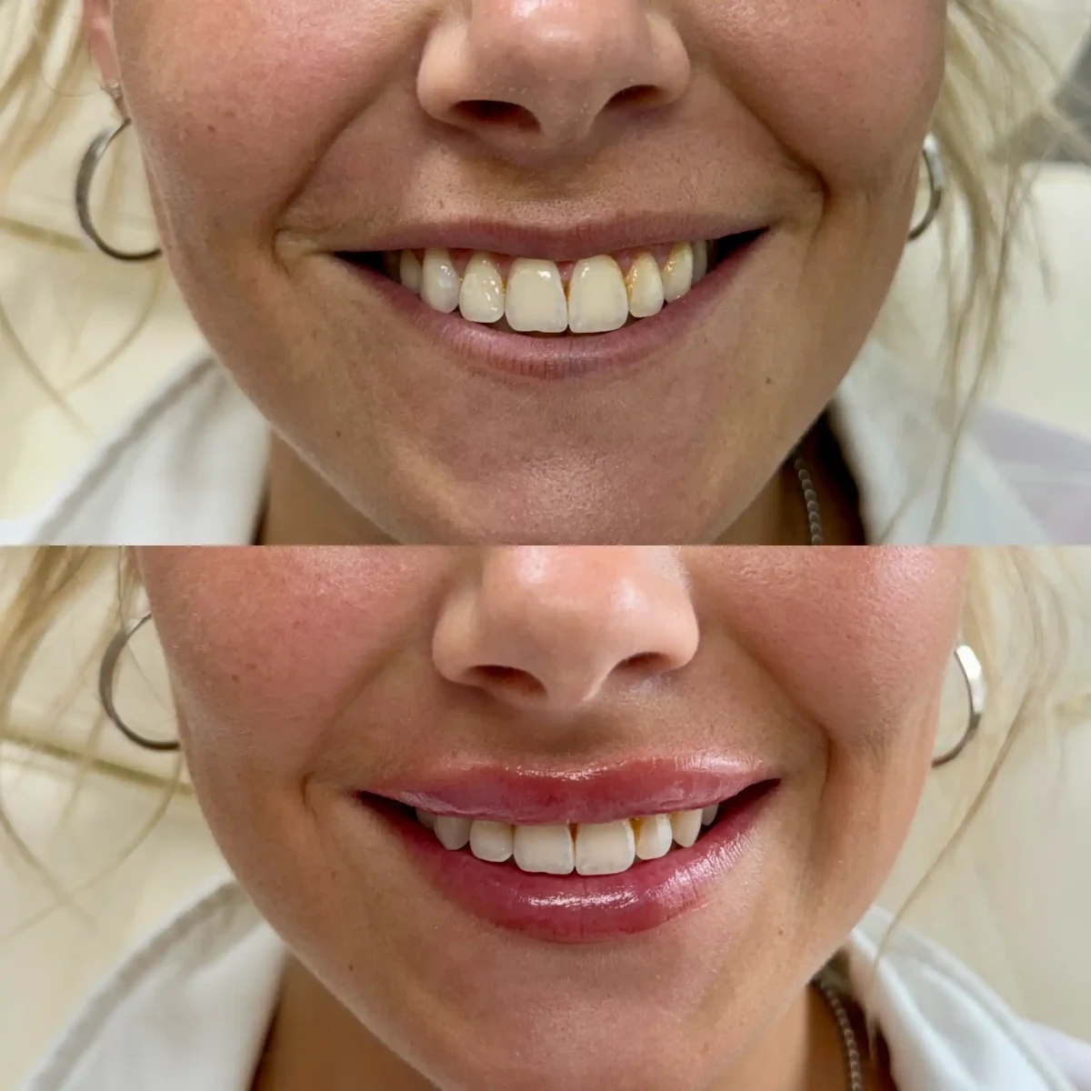Filler t-Pure Skin and Aesthetics in-Stillwater-OK