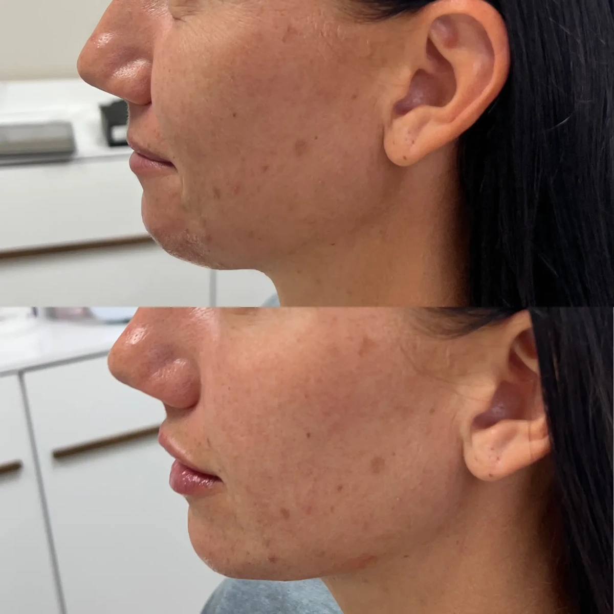 Filler u-Pure Skin and Aesthetics in-Stillwater-OK