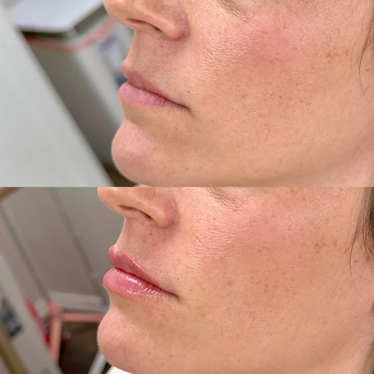 Filler w-Pure Skin and Aesthetics in-Stillwater-OK