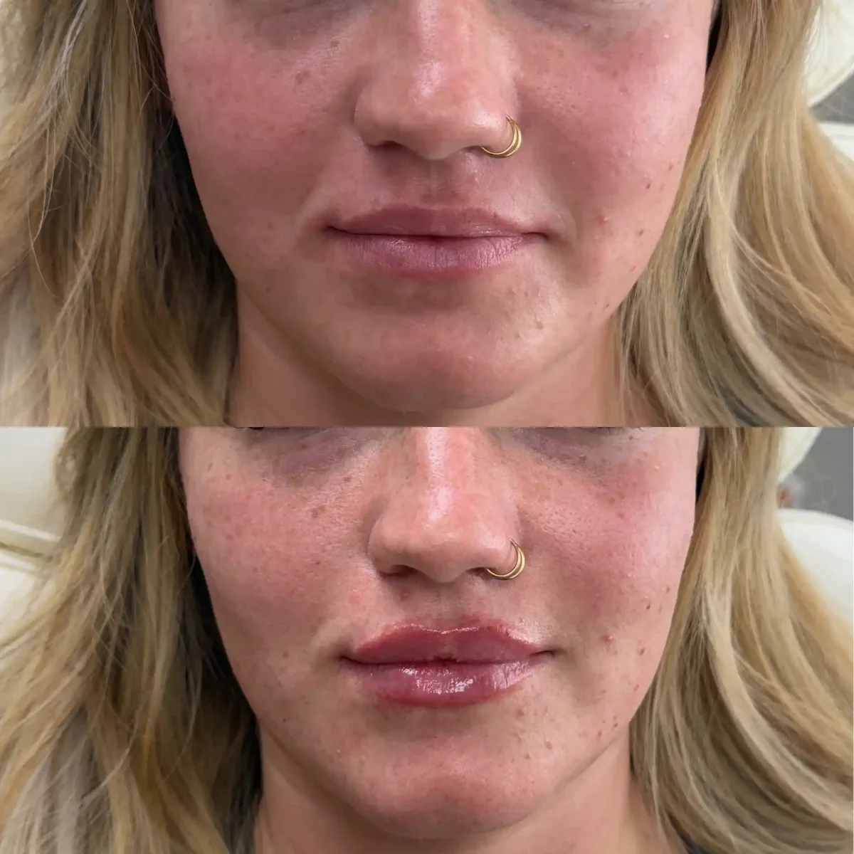 Filler x-Pure Skin and Aesthetics in-Stillwater-OK