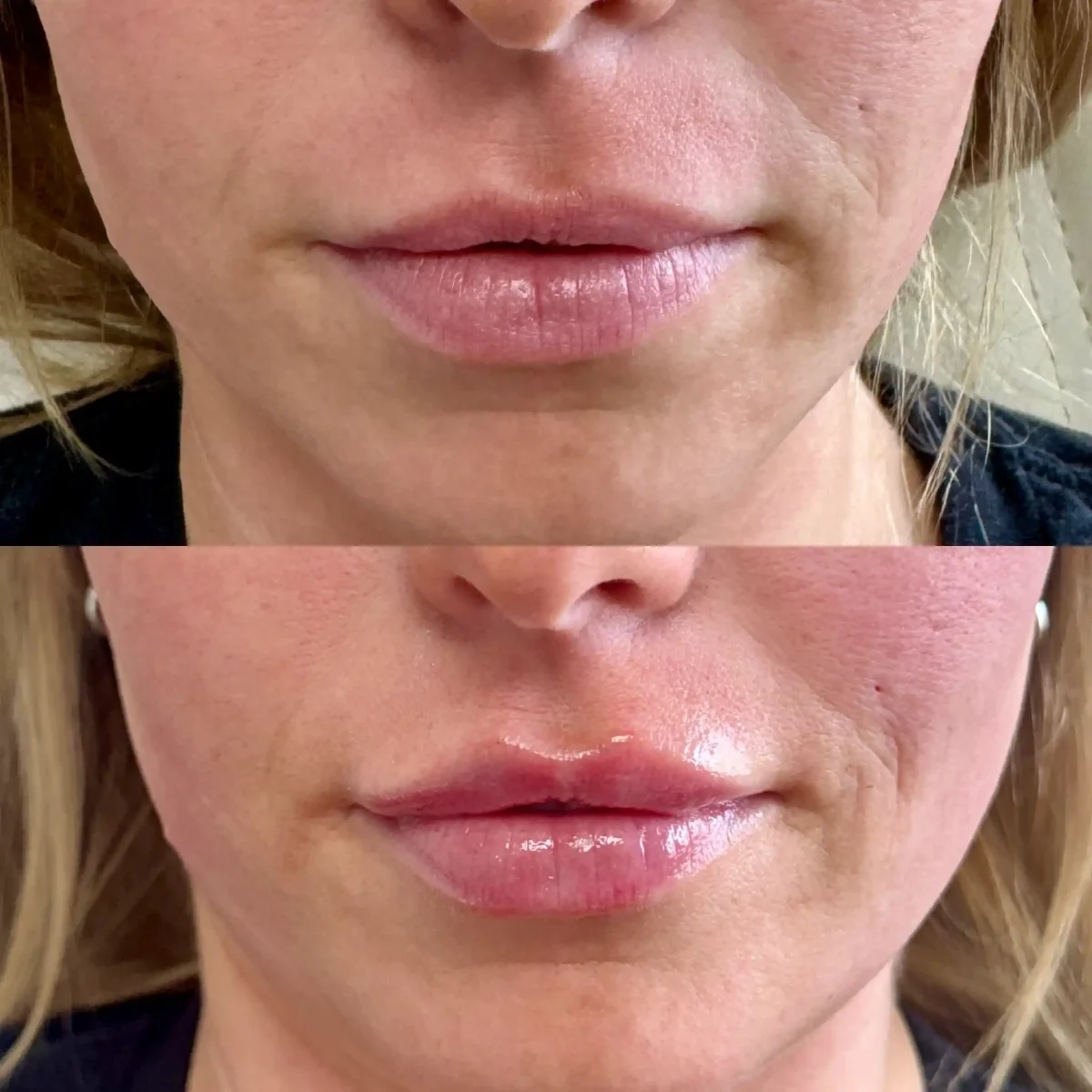 Filler y-Pure Skin and Aesthetics in-Stillwater-OK