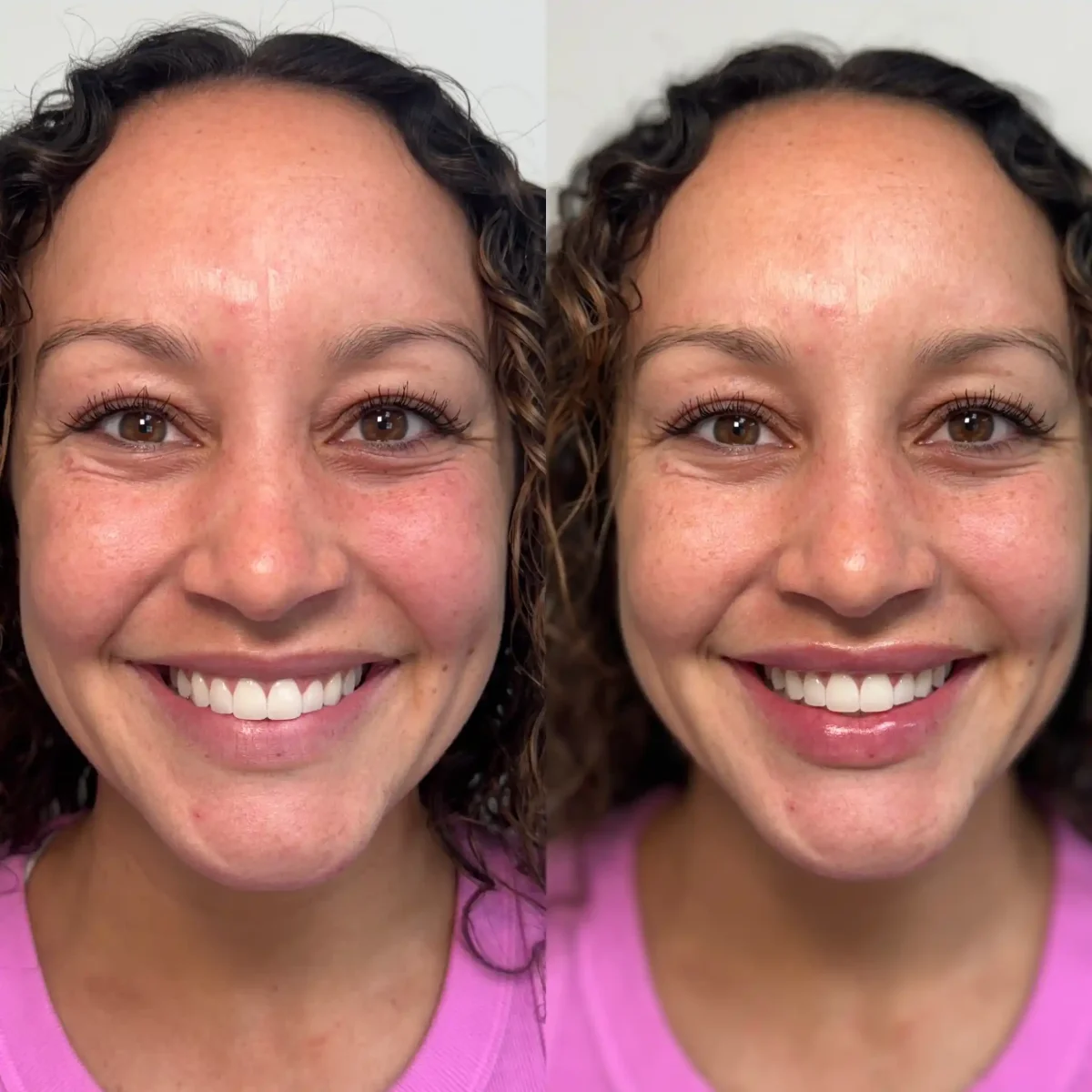 Filler z-Pure Skin and Aesthetics in-Stillwater-OK