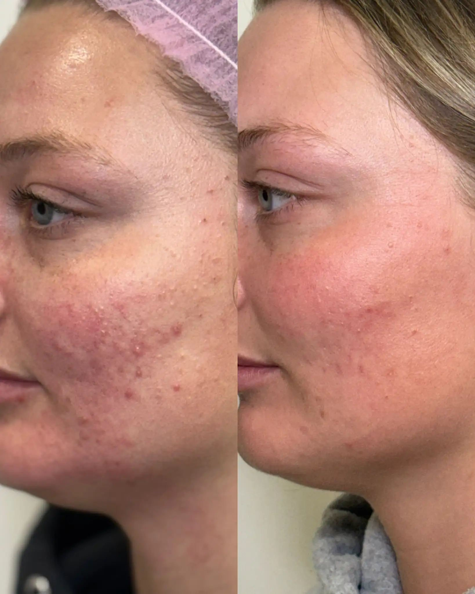 Microneedling c-Pure Skin and Aesthetics in-Stillwater-OK