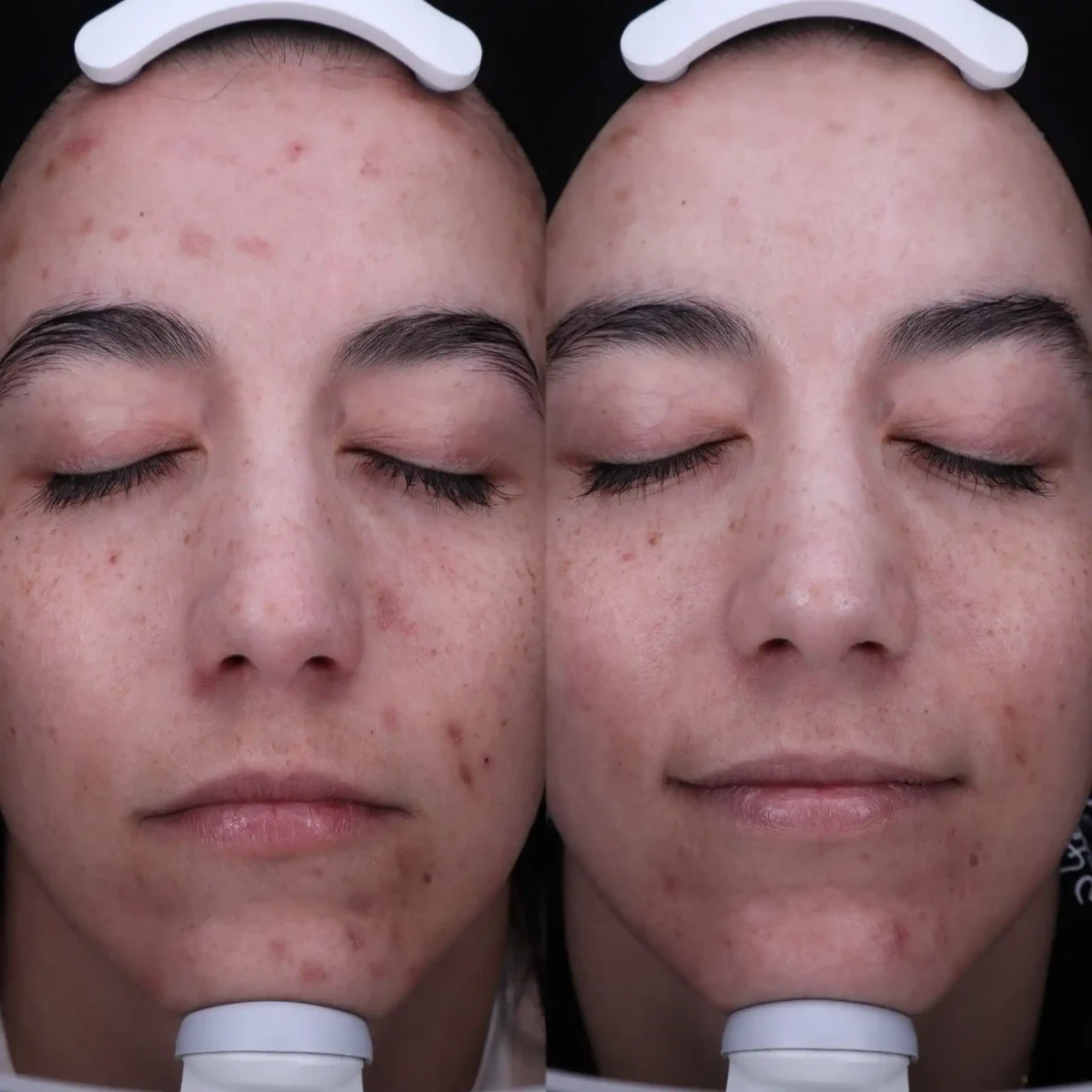 Skin-Pure Skin and Aesthetics in-Stillwater-OK