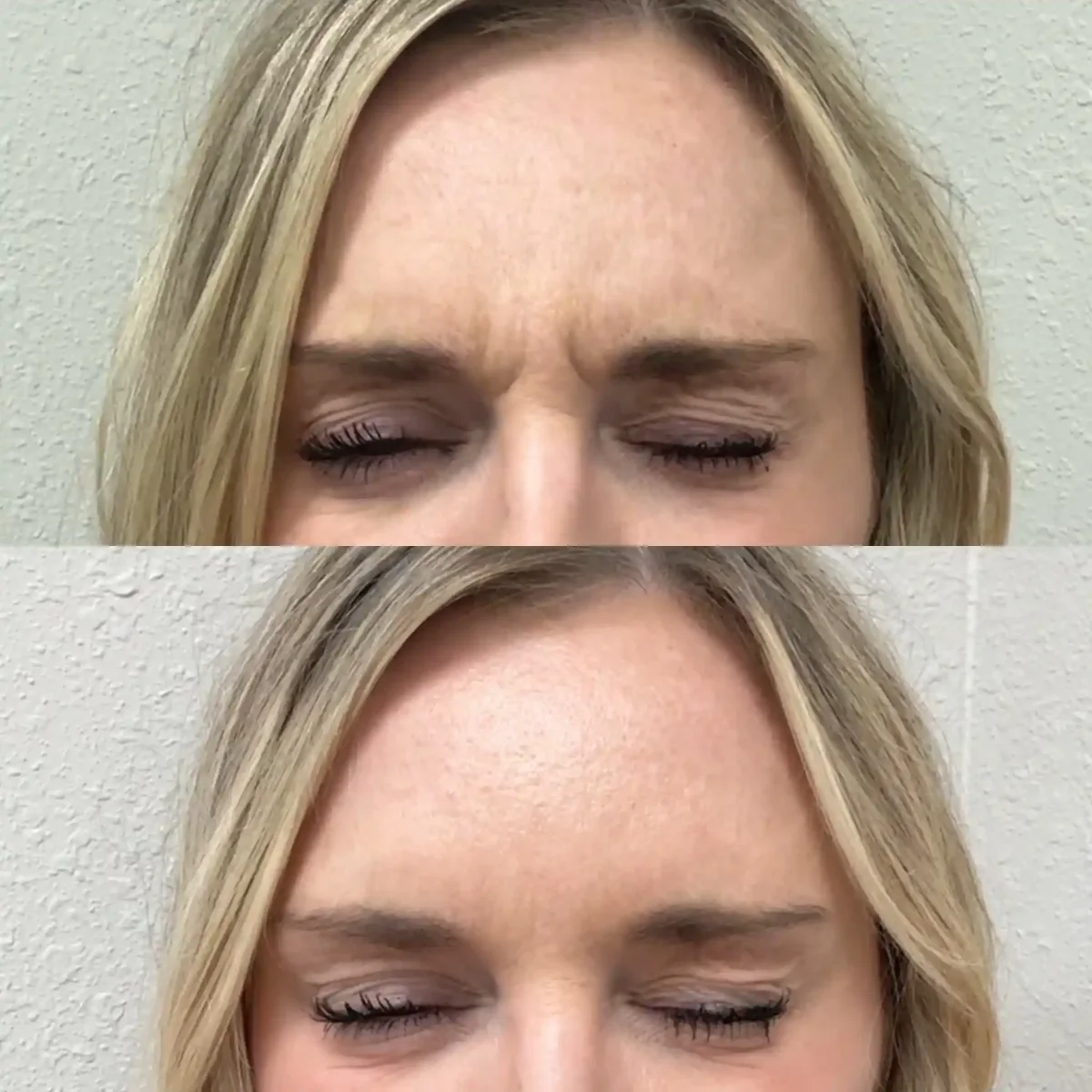 Wrinkle Relaxers P-Pure Skin and Aesthetics in-Stillwater-OK