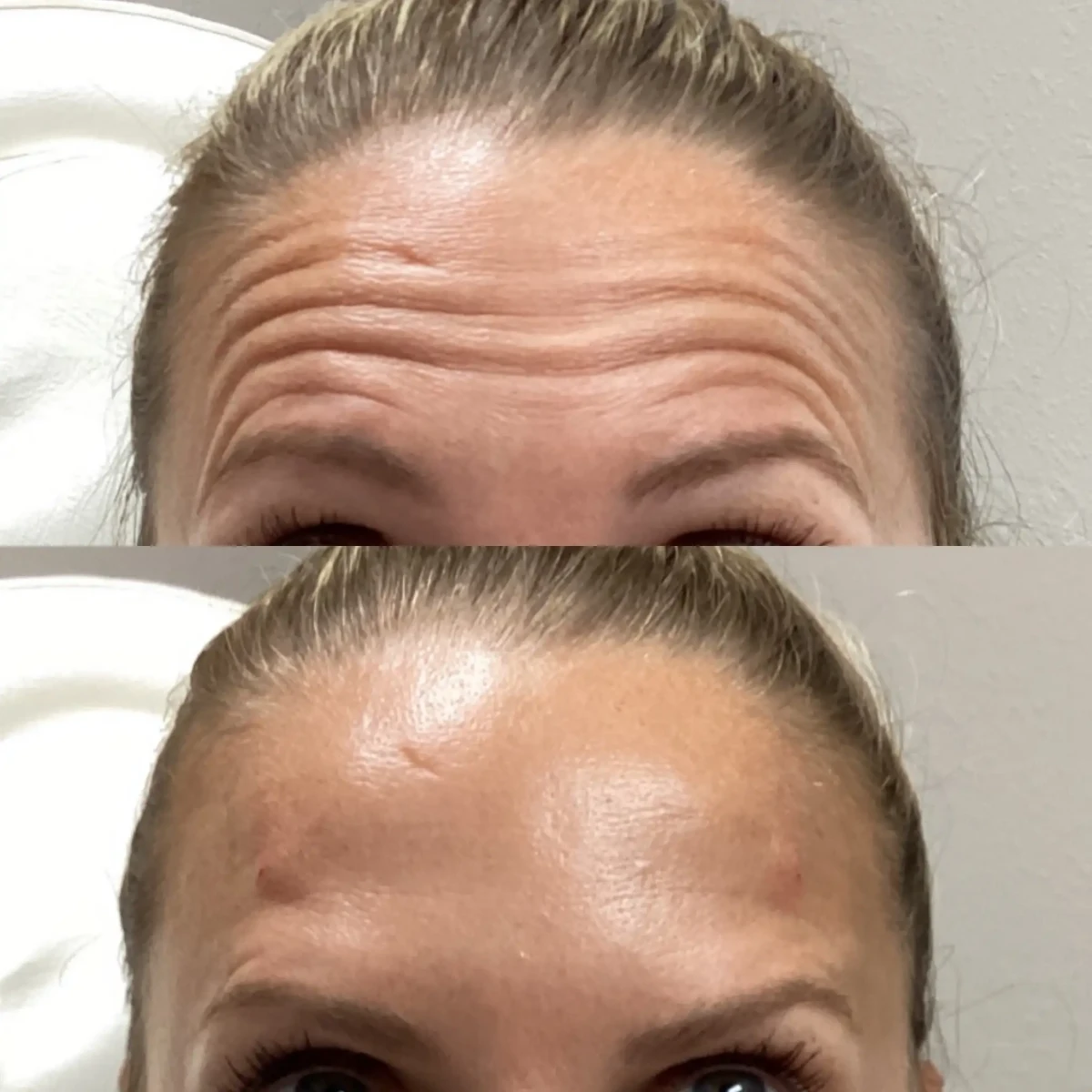 Wrinkle Relaxers-Pure Skin and Aesthetics in-Stillwater-OK