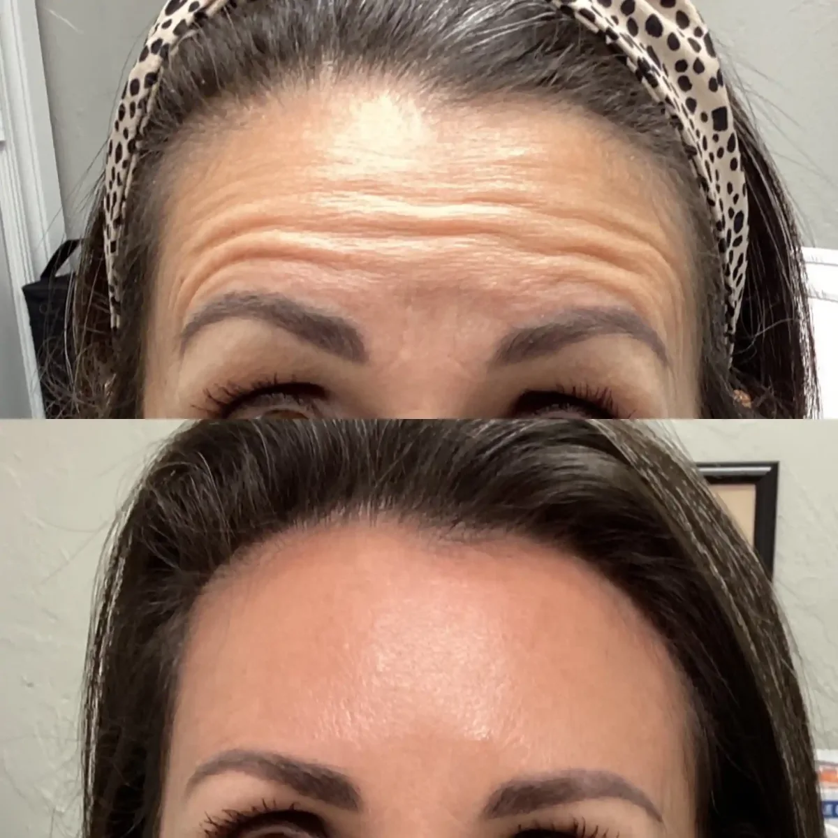 Wrinkle Relaxers c-Pure Skin and Aesthetics in-Stillwater-OK