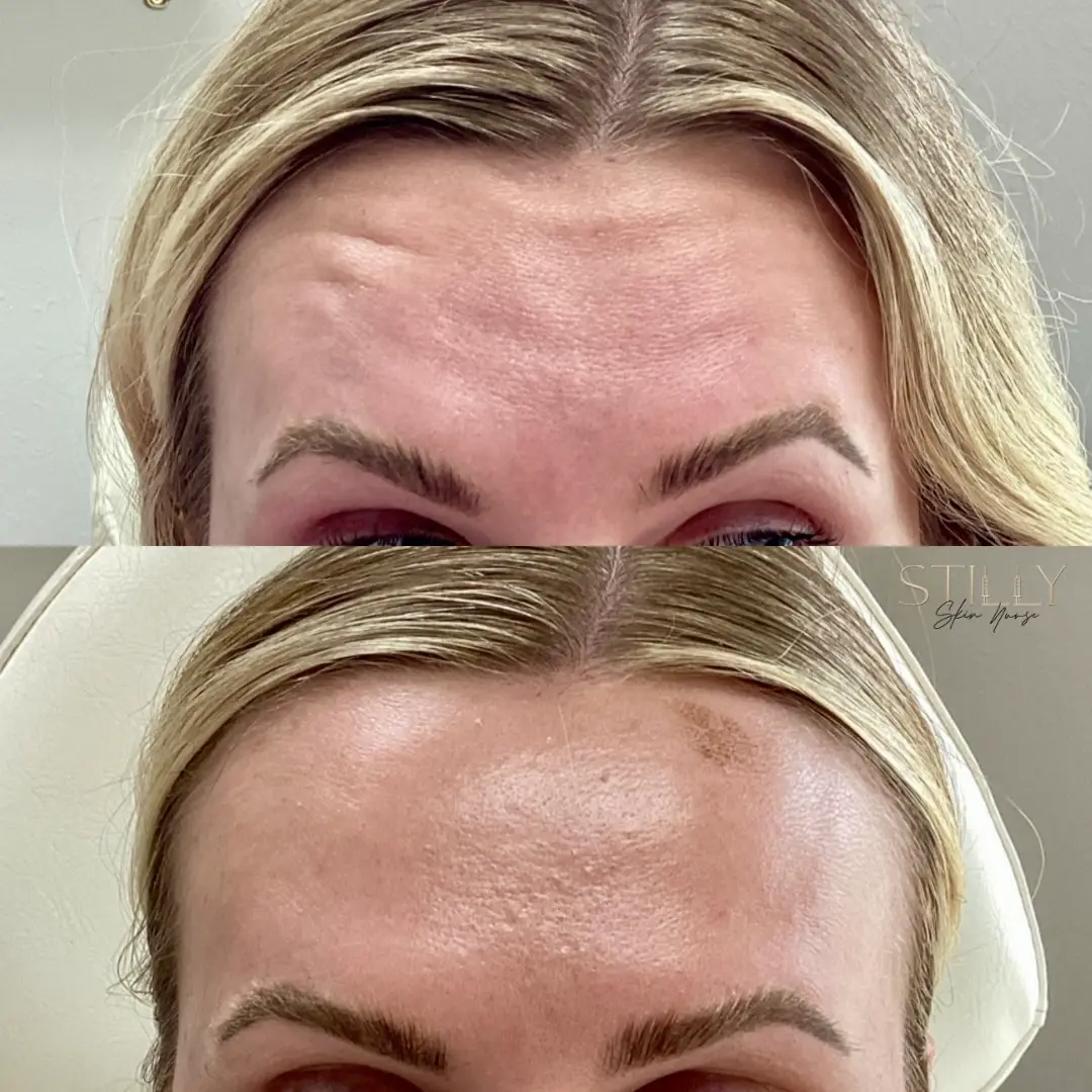 Wrinkle Relaxers i-Pure Skin and Aesthetics in-Stillwater-OK