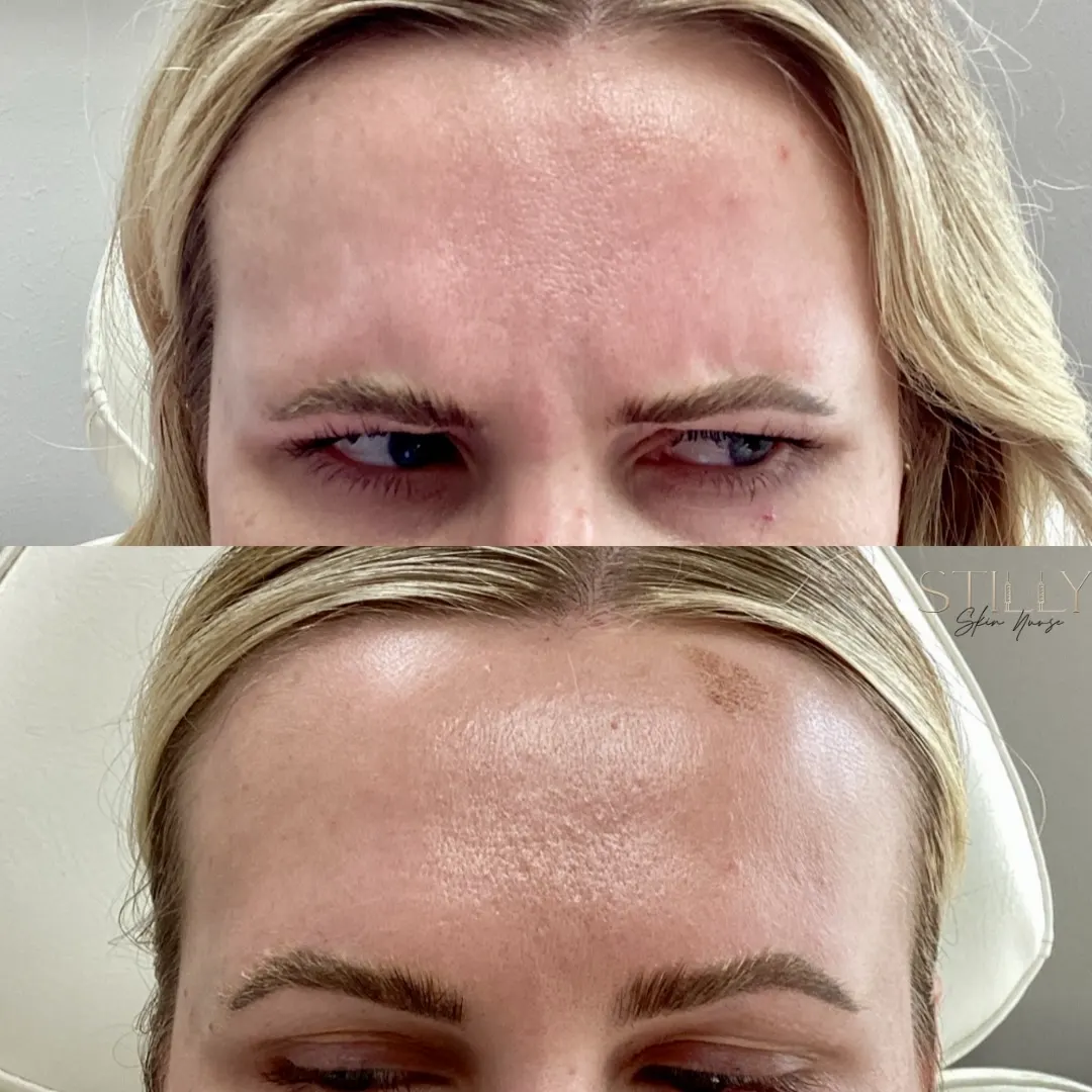 Wrinkle Relaxers l-Pure Skin and Aesthetics in-Stillwater-OK