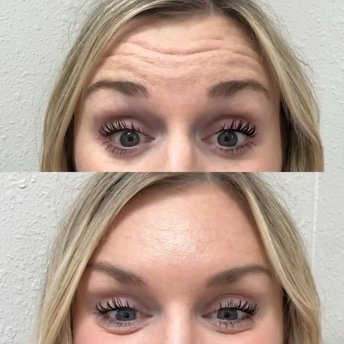 Wrinkle Relaxers o-Pure Skin and Aesthetics in-Stillwater-OK