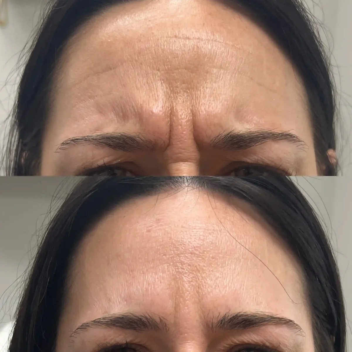 Wrinkle Relaxers r-Pure Skin and Aesthetics in-Stillwater-OK